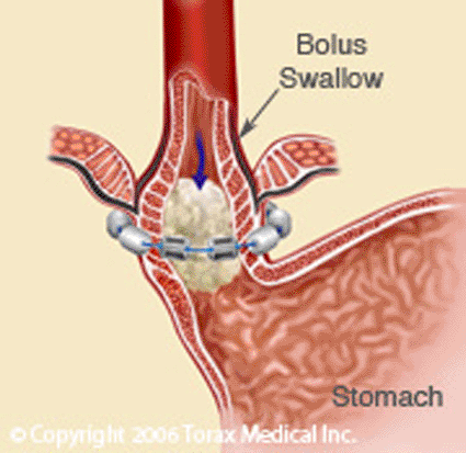 Image: The LINX device is designed to “augment” the lower esophageal sphincter to prevent reflux while accommodating normal swallow function (Photo courtesy of Torax Medical Inc.) Image: The LINX device is designed to “augment” the lower esophageal sphincter to prevent reflux while accommodating normal swallow function (Photo courtesy of Torax Medical Inc.)